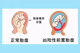 二胎孕妈妈遇上凶险性前置胎盘、胎盘植入！生娃碰到它，有些人没了子宫，有些人差点送命图片