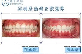牙齿不齐，前牙扭转图片