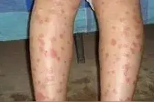 系统性红斑狼疮肾炎能生育吗？图片