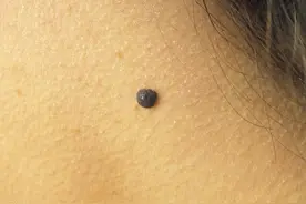普通的一颗痣，可能会癌变？这个地方的痣，或是癌细胞的“伪装”图片