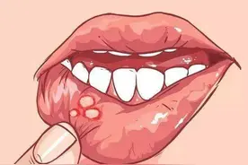 反反复复口腔溃疡，该如何用药？图片