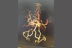 反复脑缺血、脑出血？小心这个“烟雾杀手”图片