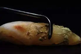 为什么有些人需要做龈下刮治？治疗过程疼吗？听听看牙医怎么说图片