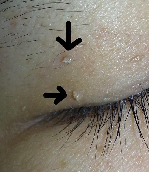 "脂肪粒"对许多人造成了很大的困扰,事实 "脂肪粒"漫衍在眼睛周围