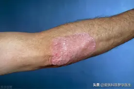 皮肤上长红斑、脱屑，是不是得了牛皮癣？图片