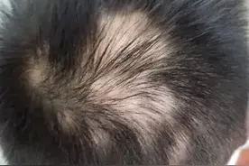 才上6年级居然已经秃了！杭州这样的病例还不少，医生说压力大是很重要原因图片