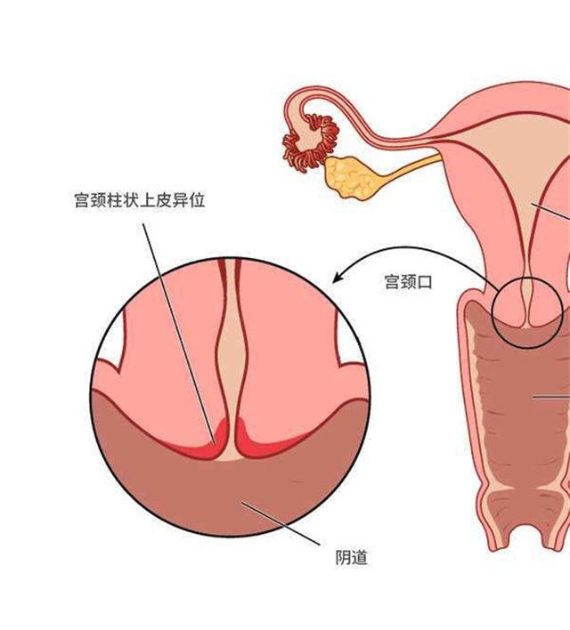 宫颈糜烂不用治？宫颈糜烂能自行恢复吗？医生辟谣来了