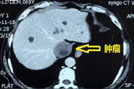 哈医大一院多学科协作成功完成一例高难复杂腹膜后肿瘤手术图片