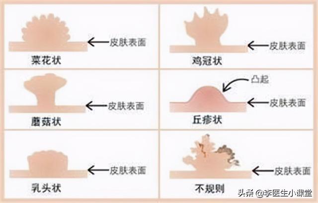 “淋病”是什么？如何治疗和预防？