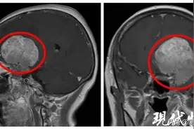 大妈突然失忆 罪魁祸首竟是脑中拳头大的肿瘤图片