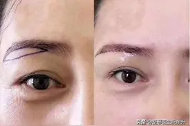 有关“提眉手术”的这几个真相，一般人医生不会与你说图片