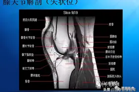膝关节MRI解剖及半月板损伤影像诊断图片