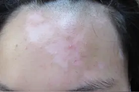 白癜风发病的最大诱因竟然是“自己”？图片