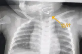 警惕小物件酿大祸！成都连发两起“婴儿误吞别针”事件图片