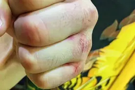 一龙被打伤，手部淤血很多，肿胀的像馒头图片