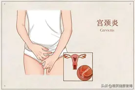 得宫颈炎就是私生活乱？正确认识宫颈炎，不信谣不传谣图片