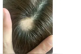 美女主持人突然上热搜，网友纷纷晒同款！脱发原来是毛囊“休息”了图片