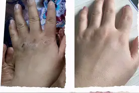 湿疹、带状疱疹，用什么药好得快？这3种皮肤病很折磨人图片