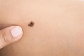 身上长的是痣还是黑色素瘤？5个明显特征，两分钟可以判断图片