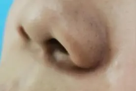 整形美容手术：带你认识鼻翼缩小术图片
