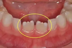小孩牙齿为什么呈锯齿状图片