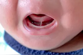 舌系带过短，要不要切开？图片