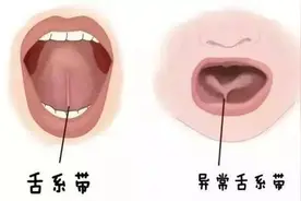 一“扫”而长的舌系带图片
