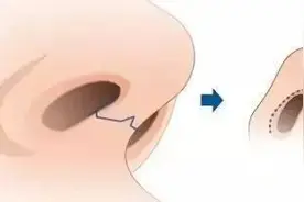 鼻整形后呼吸不畅怎么办？是正常现象吗？图片