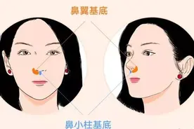 鼻基底改善对面部的影响有多大？图片