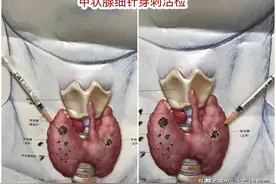 甲状腺有结节也要忌口？医生：若想结节消散，这4类食物少吃图片
