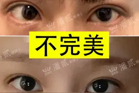 有关双眼皮修复“效果不尽人意、不完美”背后的真相，你知道么？图片