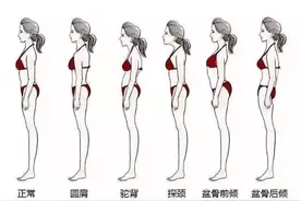 您听说过下交叉综合征吗？图片