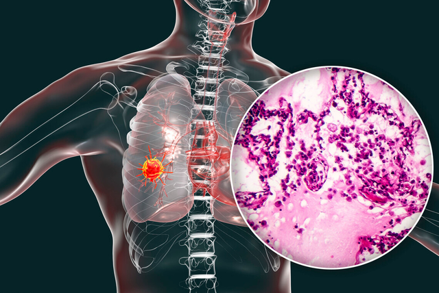 除了吸烟，吃什么更容易得肺癌？