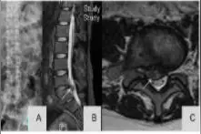 合并移行椎腰椎间盘突出症患者腰骶神经根支配区的变化图片