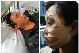 什么是面瘫？图片