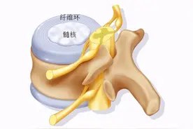 腰椎间盘突出症和椎管狭窄，这两者有啥区别？治疗上有何不同？图片