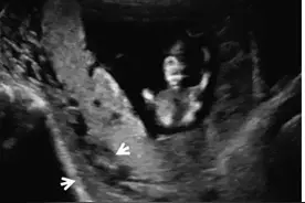 干货分享丨正常胎盘与异常胎盘的超声表现图片