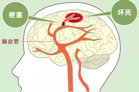 什么是脑梗，中风脑梗要怎么治疗图片