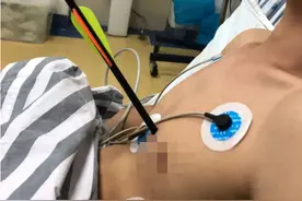 惊险！广西一男子被一箭“穿心”，离心脏只有1厘米图片