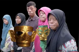 奇怪的变脸症，让他成为“怪人”！还遗传给子女，仅一人“幸免”图片