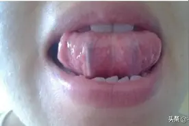 舌下青筋是怎么一回事？怎样的才是正常的？一文详细解说图片