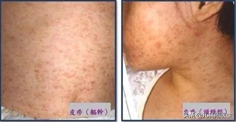宝宝脖子上有像鸡皮疙瘩是什么