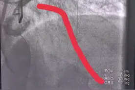 59岁男子多次心梗前兆未重视，5点心脏停跳！科普：心梗前兆图片