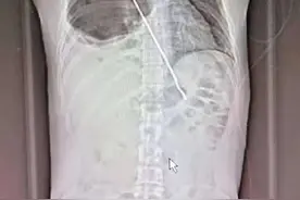惊险！不慎吞入20厘米烤肉铁签贯穿肺部图片
