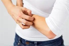医生劝告：2种食物是荨麻疹的“催化剂”，越吃越严重！避而远之图片
