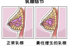 乳房结节切除，看似一劳永逸的手术，实则是将患者“画地为牢”图片