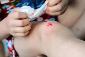 孩子受伤了，用百多邦、碘伏、紫药水、红药水？皮肤外伤怎么办？图片