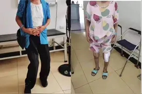 骨二科成功治疗重度双膝内外翻畸形 （顺风腿畸形）图片