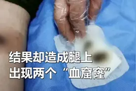女子为减肥在体内埋线20条，小腿出现几个血窟窿图片