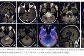 脑干肿瘤有哪些类型和新疗法？治疗、预后有何不同？图片